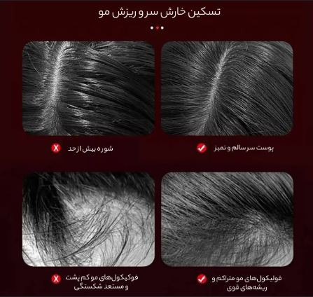 ماساژور روغن پاش و اسکالپ سر اورجینال XYT-0806